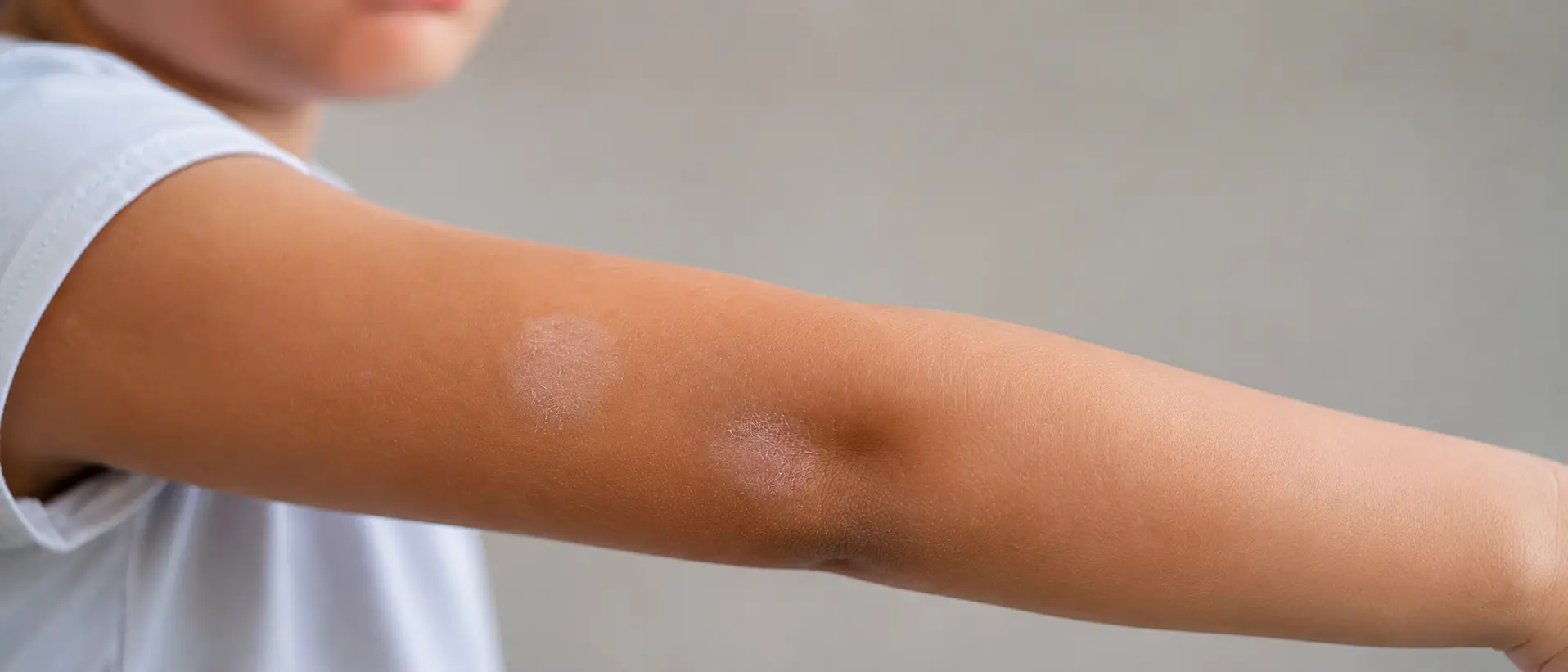 Primer plano del brazo de un niño con manchas hipopigmentadas y descamación leve compatibles con pitiriasis alba.